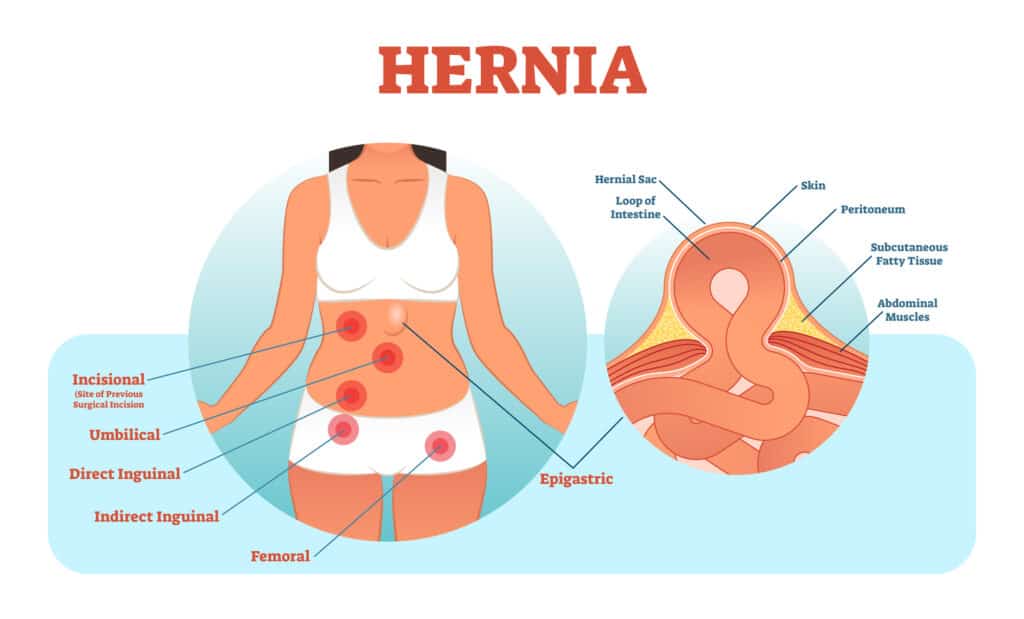 Hernia types vector illustration and cross section of muscle rupture and hernial sac. Health care informative poster.