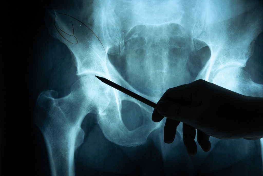 x ray for hip pain 