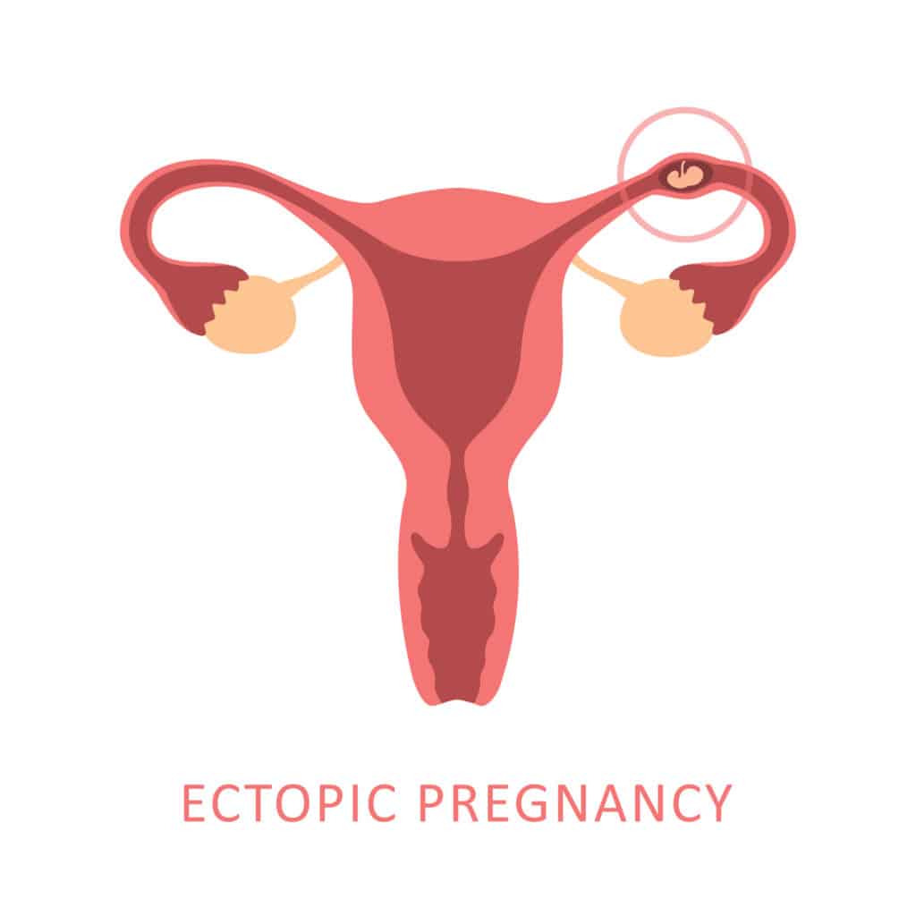 ectopic pregnancy female reproductive system women uterus