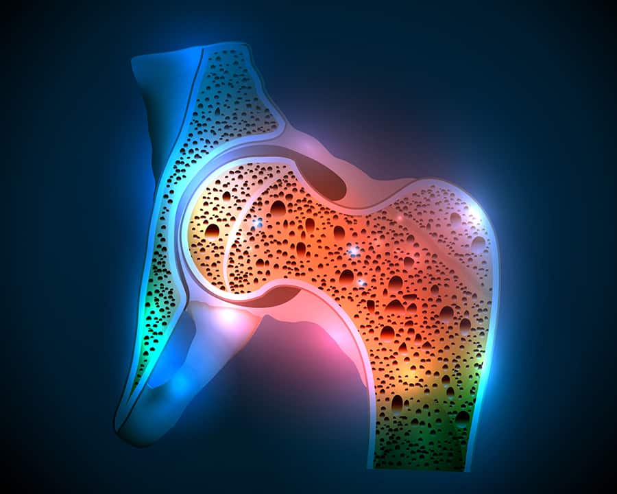 osteoporosis management for women